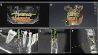Guided dental implants planning!