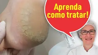 RACHADURA NOS PÉS: APRENDA A TRATAR