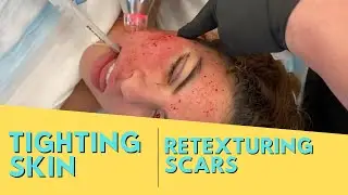 TIGHTING SKIN AND RETEXTURING SCARS | PIXEL 8 RF | Dr. Jason Emer