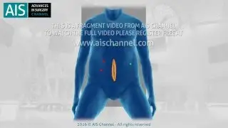 Sleeve gastrectomy in a patient with previous surgeries