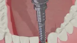 Установка импланта Adin