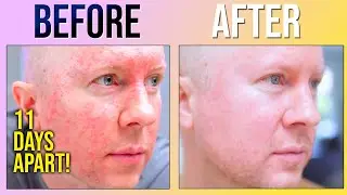 Face Flare-Up? Here's How to Calm Your Rosacea/Dermatitis/Acne FAST!