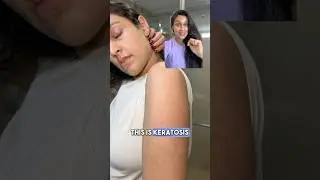 How did I treat my STRAWBERRY🍓SKIN/KERATOSIS PILARIS? 