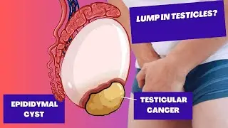 Testicular Lumps | Epididymal Cyst and Testicular Cancer