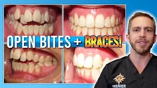 Open Bite Braces Treatment [BEFORE & AFTER!]