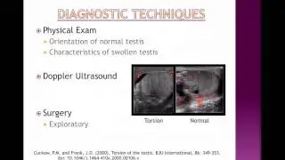 Testicular Torsion