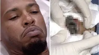 Dr Pimple Popper squeezes masses of black pus from chest: 'It's like mud' | BS NEWS