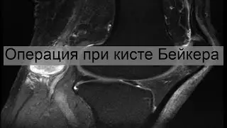 Операция при кисте Бейкера