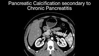 Pancreatic Calcification secondary to Chronic Pancreatitis