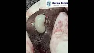 Popped Scrotal cysts !!!