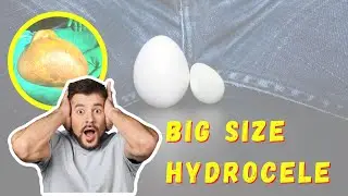 Largest hydrocele | hydrocelectomy #drrksingh #definitecure