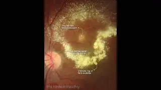 Retinal Arteriolar Macroaneurysm
