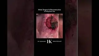 Mohs Skin Cancer Reconstruction of the Nose using Interpolation Flap Closure | Dr. Hooman Khorasani