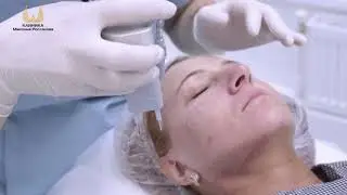 СО2 лазерное фракционное омоложение лица (ДОТ+RF омоложение)