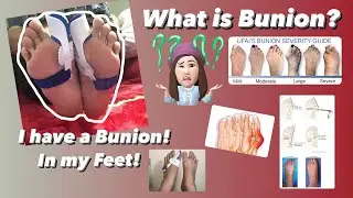 Living Alone Diaries | I have a Bunion! Masakit ba? What is Bunion?