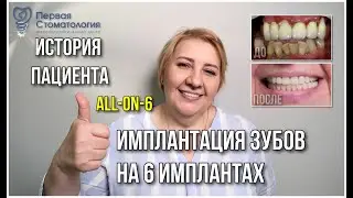 Имплантация зубов на 6 имплантах. История пациента.