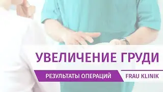 Увеличение груди от А.И. Филиппова имплантатами среднего профиля