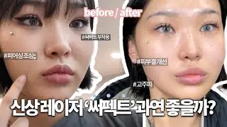완전 신상레이저 써펙트!! 과연 할만할까?🤔 리얼 찐 리뷰 가져왔다!!