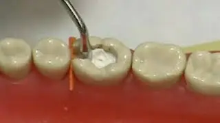 Liner & base preparation and application for deep cavity ( pulp protection)  temporary restoration.