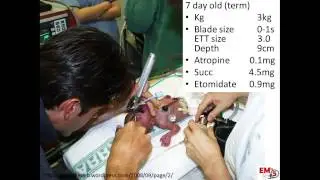 Neonatal Resuscitation