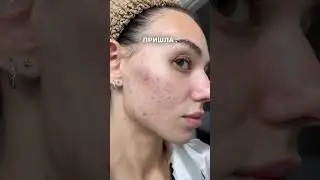 ПОЧЕМУ НЕЛЬЗЯ ВЫДАВЛИВАТЬ ПРЫЩИ? 