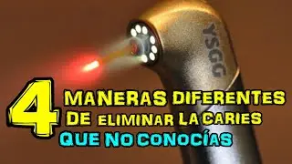 4 MANERAS DIFERENTES DE ELIMINAR LA CARIES QUE NO CONOCÍAS - Dr. Rod
