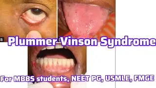Plummer vinson disease and esophageal web For MBBS students, Neet PG, Usmle, FMGE I NEET PG, USMLE