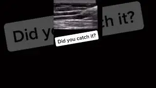 Ultrasound blood draw negative pressure vein collapse #vascularaccess #nurse #phlebotomy