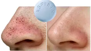 The most effective acne removal mask! Aspirin removes blackheads and acne!