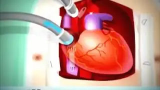 Heart Surgery Coronary Artery Bypass CABG