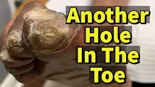Another  Hole In The Toe: Ulcer, Fungal Toenails, and Calluses