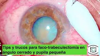 Tips y trucos para faco en glaucoma de ángulo cerrado y pupila pequeña