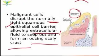Paget's Disease of the Nipple/Breast