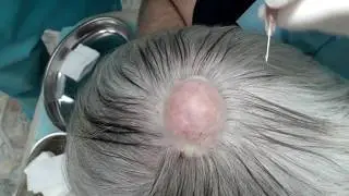 Удаление большого жировика (атеромы) на голове
