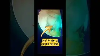 Meniscus Broken in 2 Part 💥 घुटने की गद्दी मेनिस्कस गई काम से #meniscustear #meniscus #kneeinjury