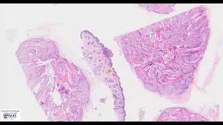 Skin: Pilomatrixoma Microscopy (Talking slide)