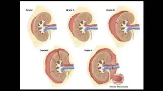 Blunt Abdominal Trauma Part 4   Renal Injury