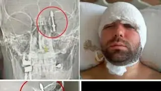 PRAVDA O ZUBNYCH IMPLANTATOCH co ti nik nepovie