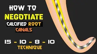 How to negotiate calcified root canals