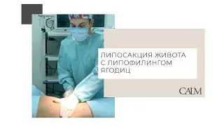 Липосакция живота + липофилинг ягодиц