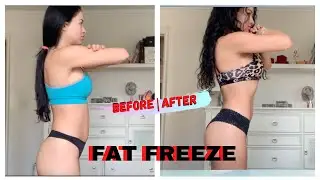 FAT FREEZING| BEFORE AND AFTER #CRYOSCULPT