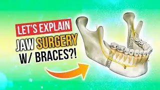 Jaw Surgery with Braces and Other Alternatives