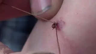 If the tick has bitten. Removal of a tick How to remove a tick