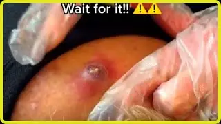 Massive Cyst Popping BIGGEST #내성발톱 #ingrownhair #blackheads  #blackhead #pimple #foryou #acne #fyp