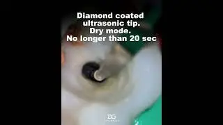 Fiber post removal. 
