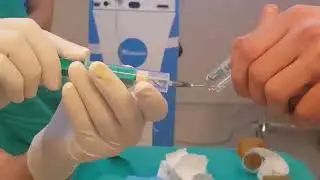Epidural ve spinal (kombine lokal anestezi) nasıl yapılır ve ardından doğum görüntüleri.