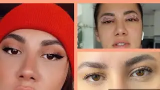 göz kapağı ameliyatı oldum sonuç istediğim gibi