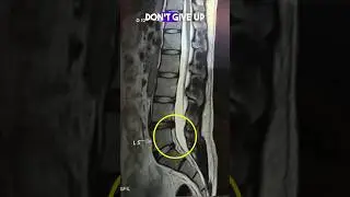 Lumbar disc bulges recovery after 4 years 
