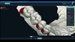 Designing and printing a splint with DentaMile connect