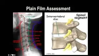 Cervical Spine X-Ray